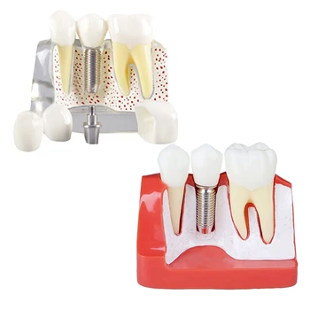 Модел за демонстрация на зъби Имплант Подвижен анализ Коронен мост за комуникация с пациента